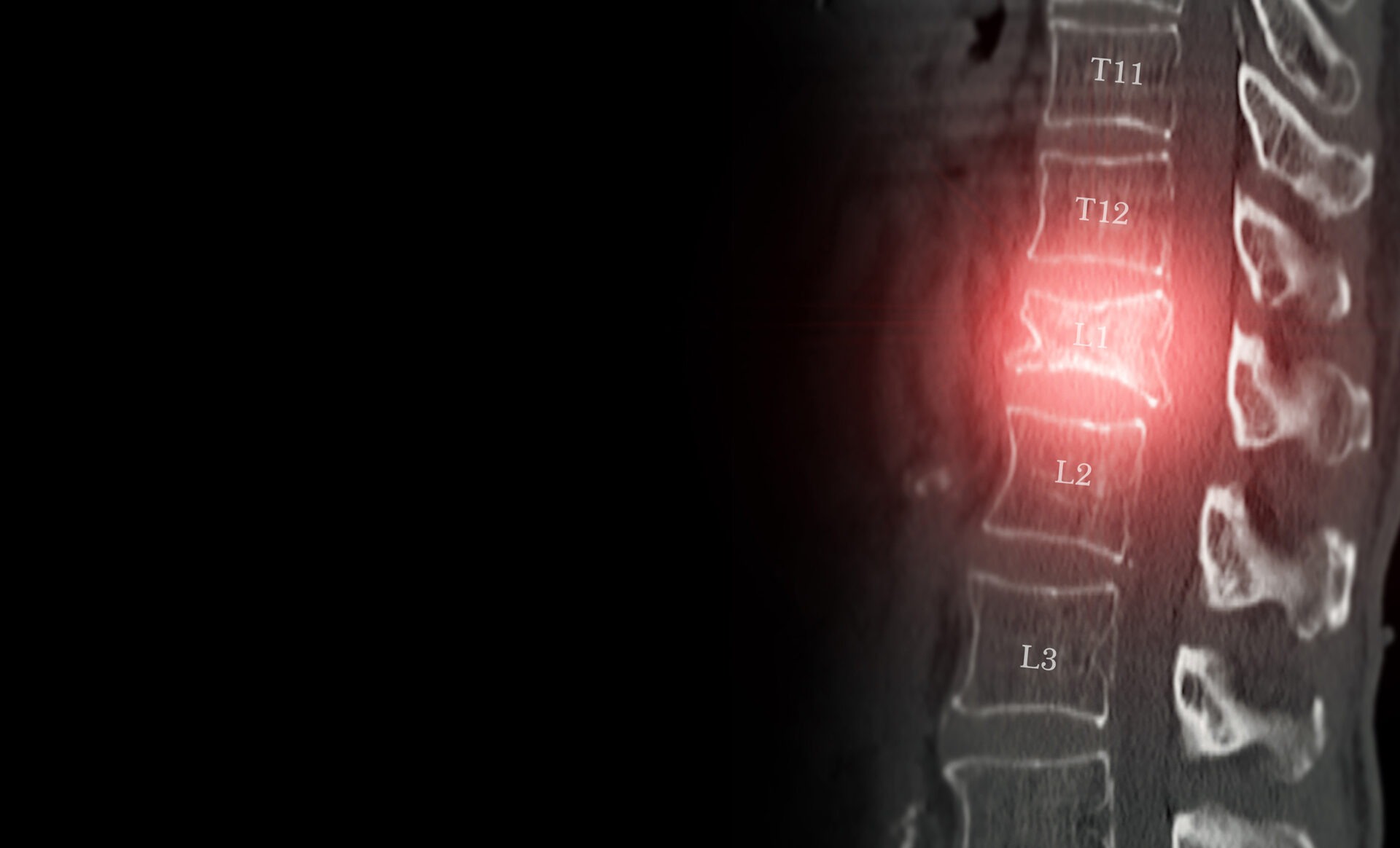 A vivid CT scan image highlighting a compression fracture at the L1 level of the lumbar spine